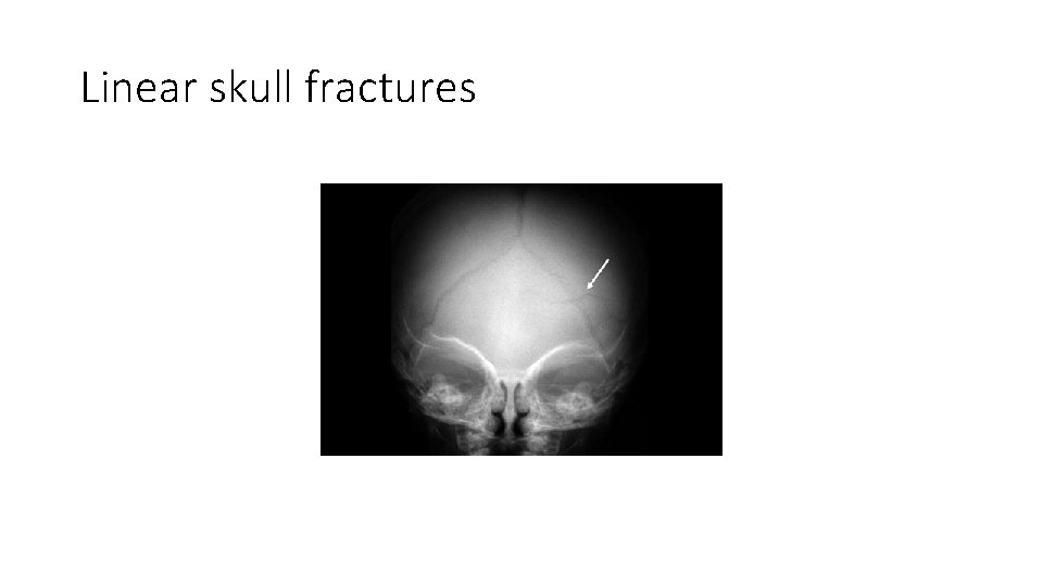 Linear skull fractures 