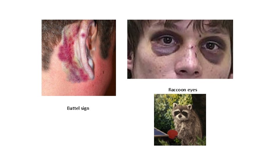 Raccoon eyes Battel sign 