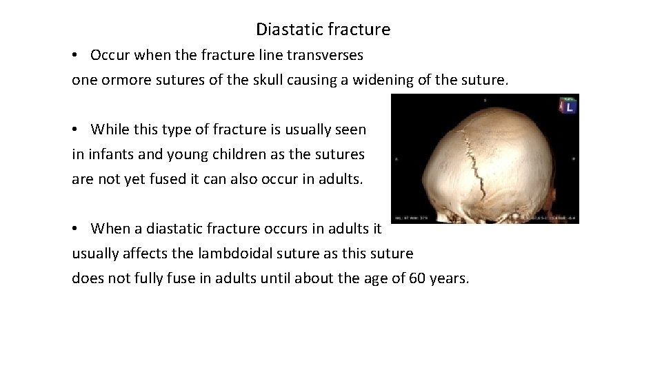 Diastatic fracture • Occur when the fracture line transverses one ormore sutures of the