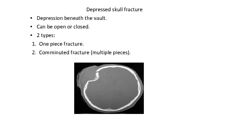 Depressed skull fracture • Depression beneath the vault. • Can be open or closed.