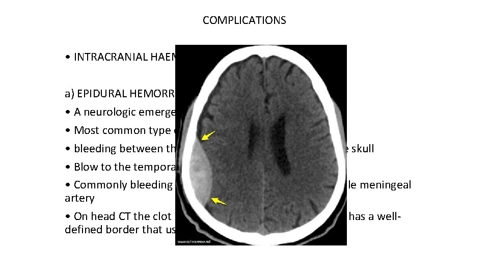 COMPLICATIONS • INTRACRANIAL HAEMORRHAGES : a) EPIDURAL HEMORRHAGE • A neurologic emergency • Most