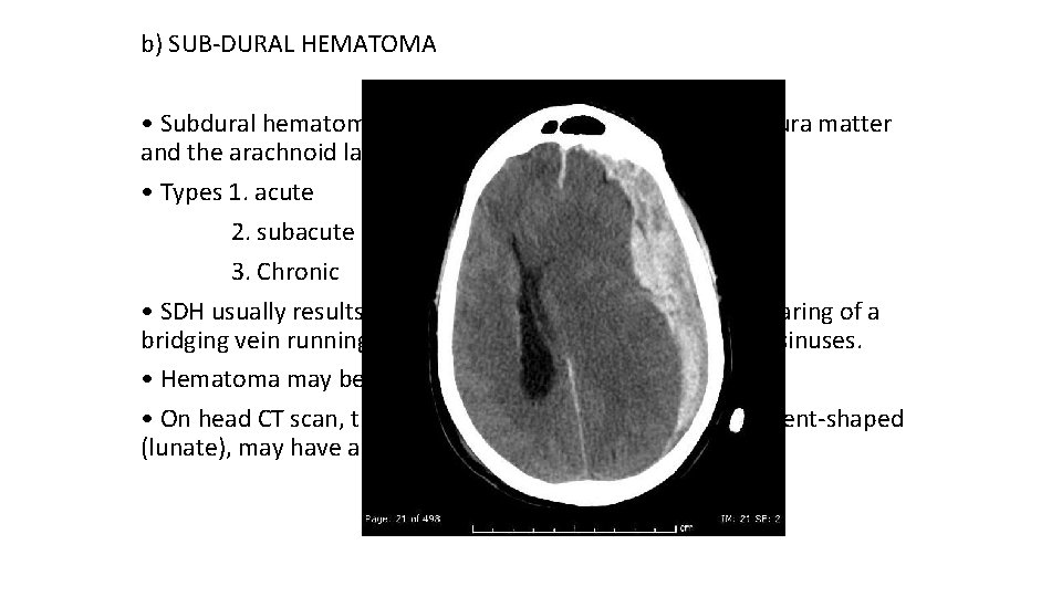 b) SUB-DURAL HEMATOMA • Subdural hematoma occurs from bleeding between the dura matter and