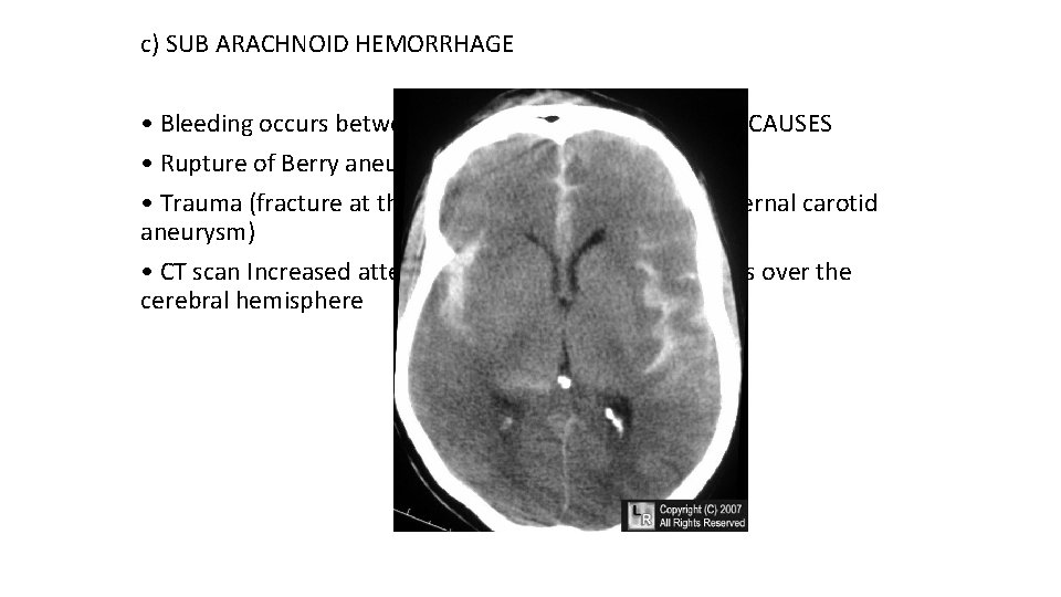 c) SUB ARACHNOID HEMORRHAGE • Bleeding occurs between the arachnoid and pia mater CAUSES