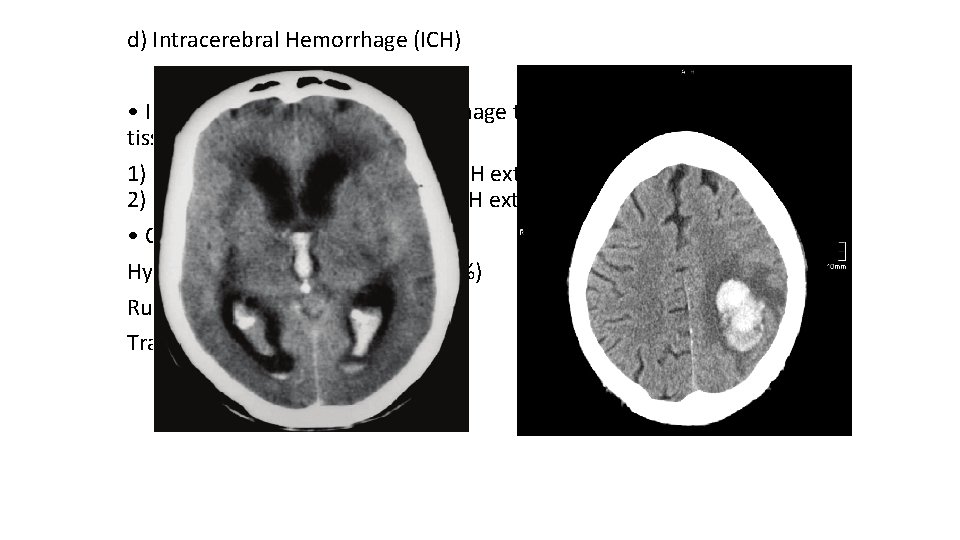 d) Intracerebral Hemorrhage (ICH) • Intraaxial hemorrhage is hemorrhage that occurs within the brain