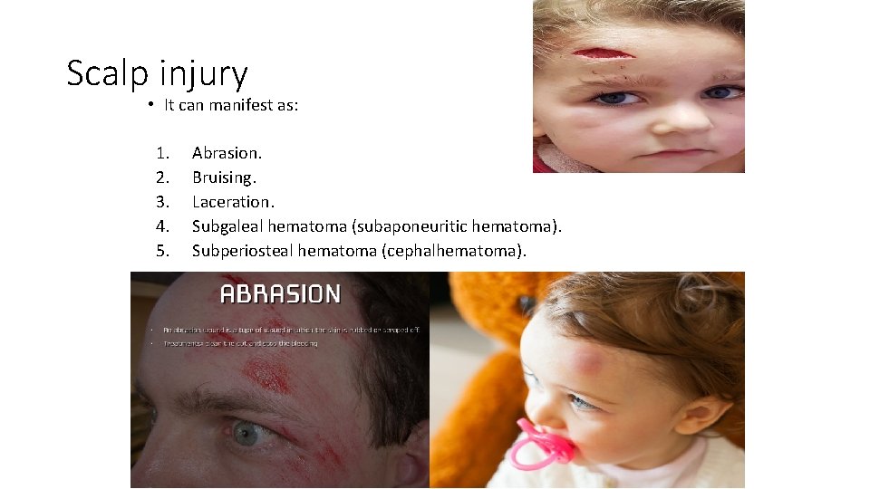 Scalp injury • It can manifest as: 1. 2. 3. 4. 5. Abrasion. Bruising.