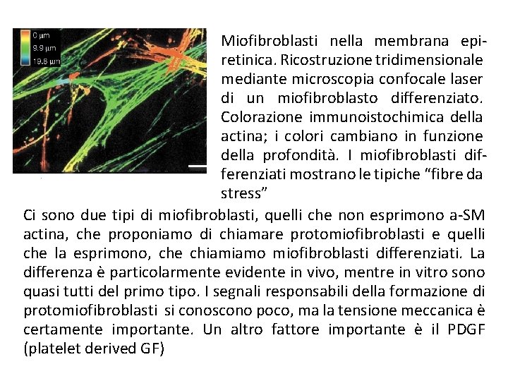 Miofibroblasti nella membrana epiretinica. Ricostruzione tridimensionale mediante microscopia confocale laser di un miofibroblasto differenziato.