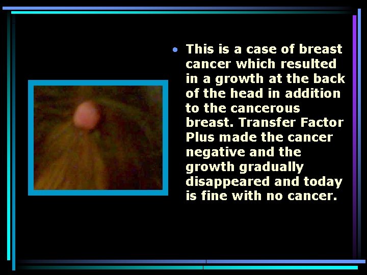  • This is a case of breast cancer which resulted in a growth