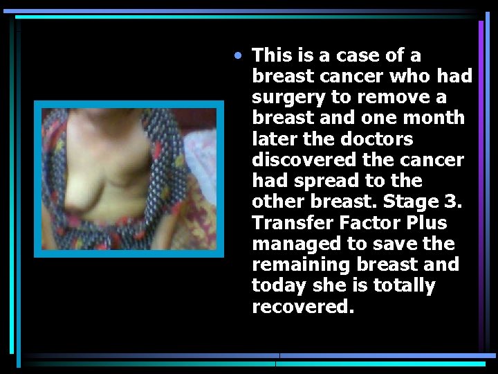  • This is a case of a breast cancer who had surgery to