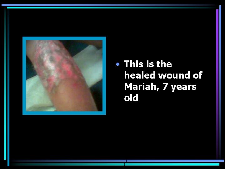  • This is the healed wound of Mariah, 7 years old 