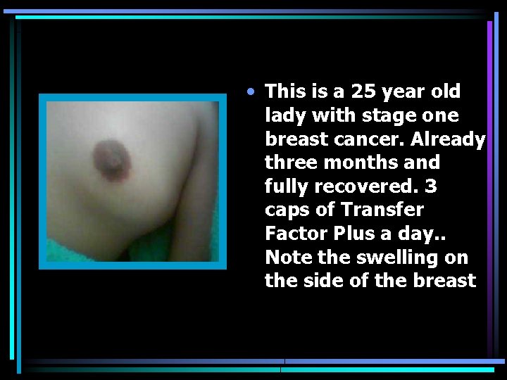  • This is a 25 year old lady with stage one breast cancer.