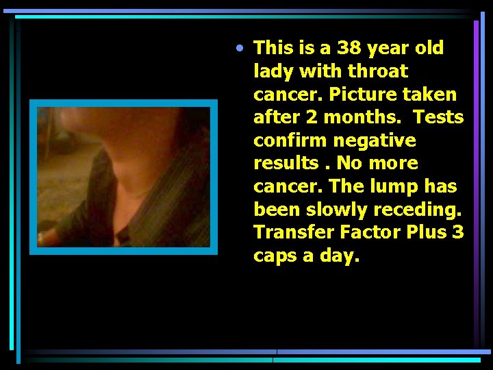  • This is a 38 year old lady with throat cancer. Picture taken