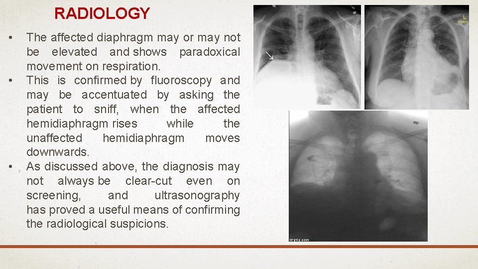 RADIOLOGY • • • The affected diaphragm may or may not be elevated and