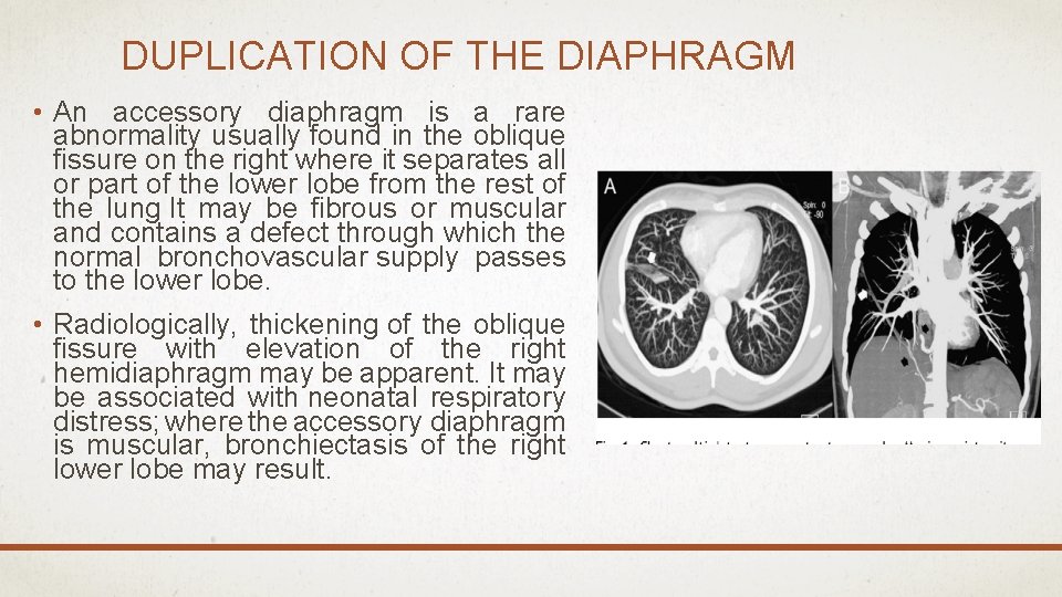 DUPLICATION OF THE DIAPHRAGM • An accessory diaphragm is a rare abnormality usually found