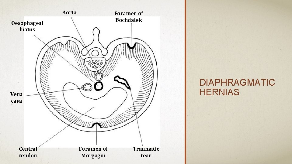 Aorta Foramen of Bochdalek Oesophageal hiatus DIAPHRAGMATIC HERNIAS Vena cava Central tendon Foramen of