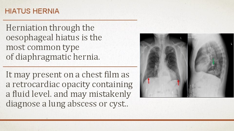 HIATUS HERNIA Herniation through the oesophageal hiatus is the most common type of diaphragmatic