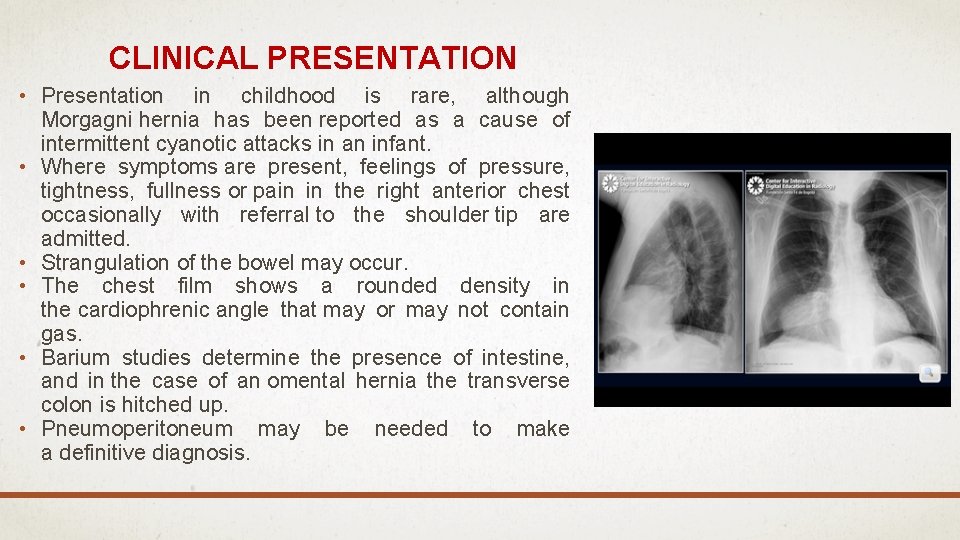 CLINICAL PRESENTATION • Presentation in childhood is rare, although Morgagni hernia has been reported