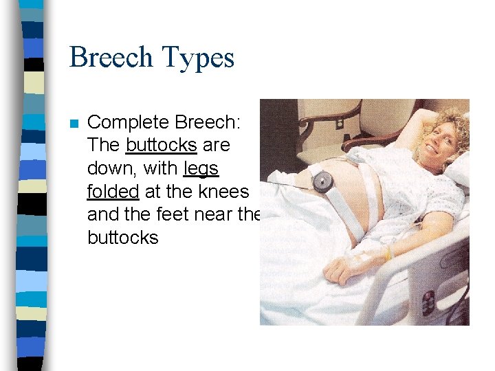 Breech Types n Complete Breech: The buttocks are down, with legs folded at the