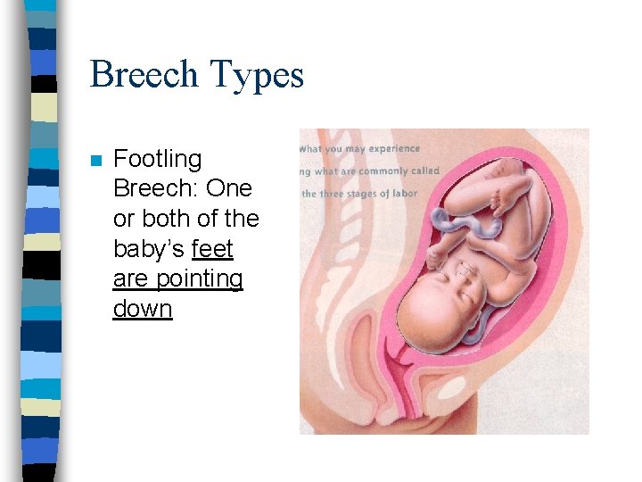 Breech Types n Footling Breech: One or both of the baby’s feet are pointing