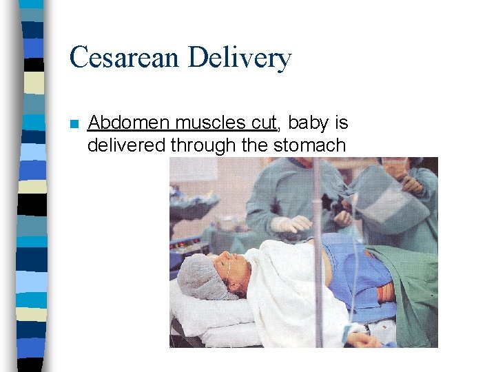 Cesarean Delivery n Abdomen muscles cut, baby is delivered through the stomach 