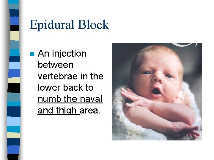 Epidural Block n An injection between vertebrae in the lower back to numb the