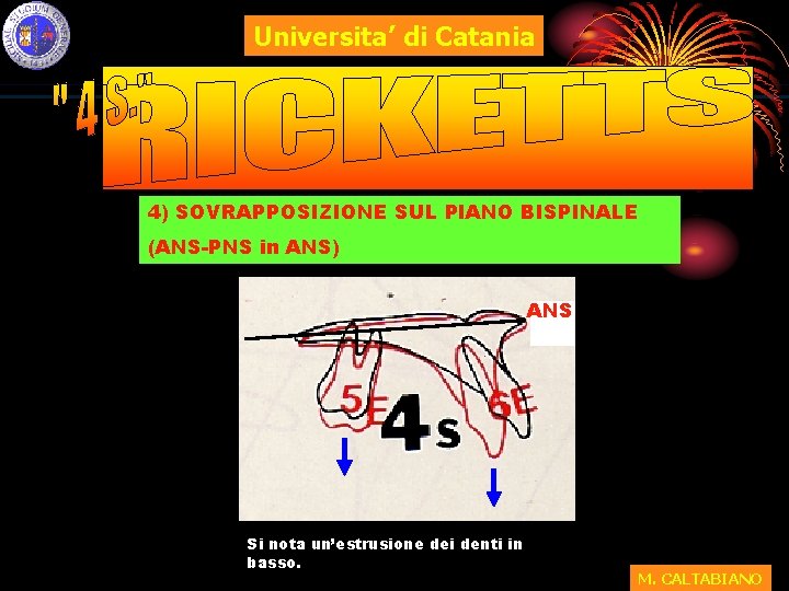 Universita’ di Catania 4) SOVRAPPOSIZIONE SUL PIANO BISPINALE (ANS-PNS in ANS) ANS Si nota