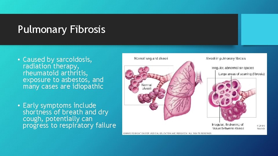 Pulmonary Fibrosis • Caused by sarcoidosis, radiation therapy, rheumatoid arthritis, exposure to asbestos, and