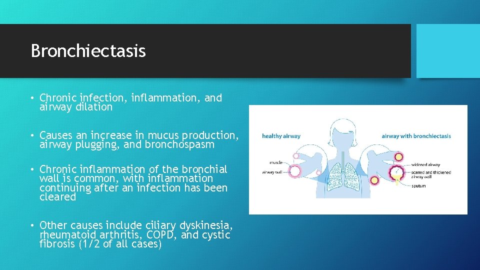 Bronchiectasis • Chronic infection, inflammation, and airway dilation • Causes an increase in mucus