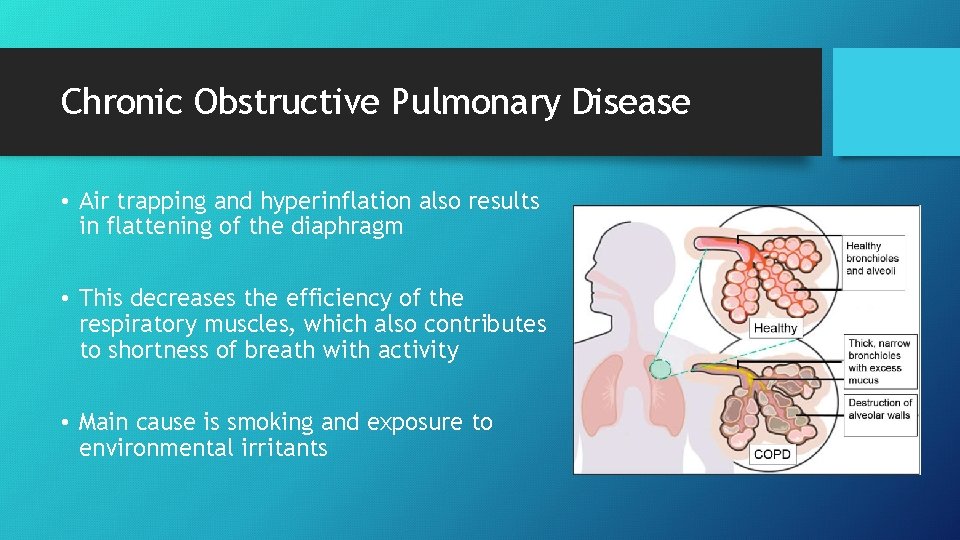 Chronic Obstructive Pulmonary Disease • Air trapping and hyperinflation also results in flattening of