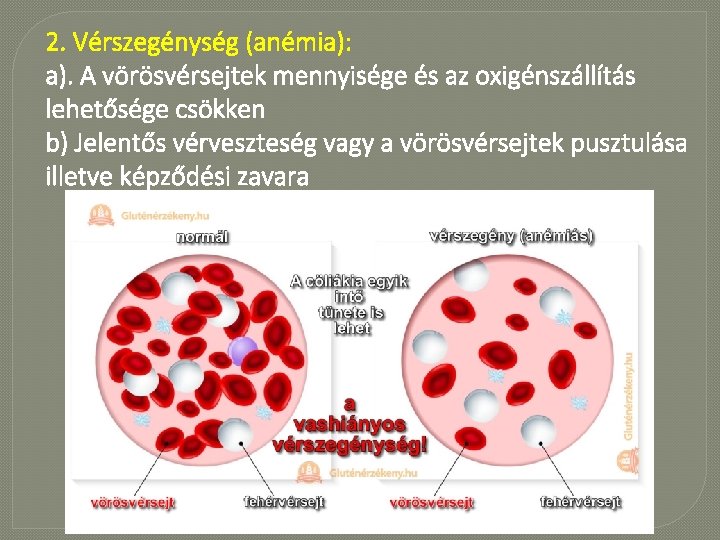 2. Vérszegénység (anémia): a). A vörösvérsejtek mennyisége és az oxigénszállítás lehetősége csökken b) Jelentős