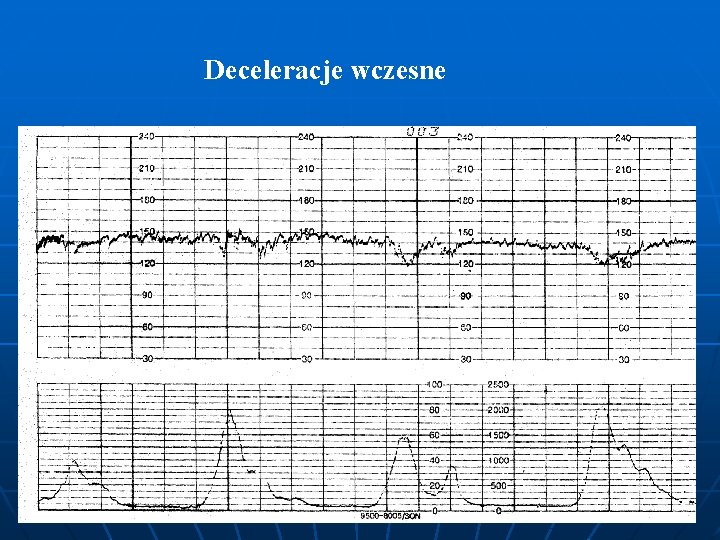 Deceleracje wczesne 