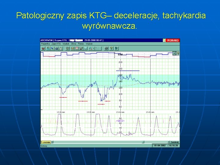 Patologiczny zapis KTG– deceleracje, tachykardia wyrównawcza. 