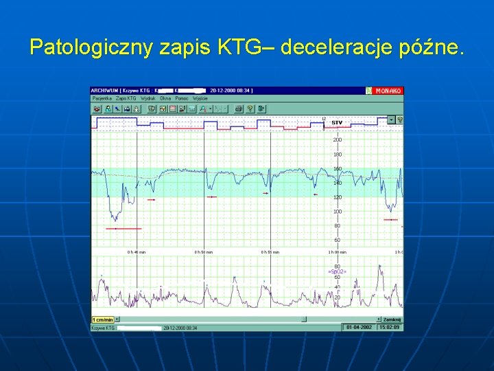 Patologiczny zapis KTG– deceleracje późne. 