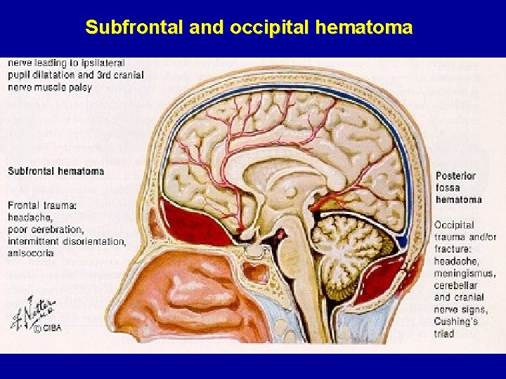 Subfrontal and occipital hematoma 