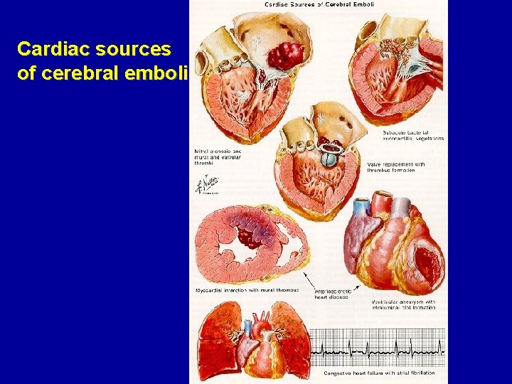 Cardiac sources of cerebral emboli 