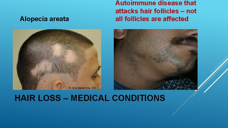 Alopecia areata Autoimmune disease that attacks hair follicles – not all follicles are affected