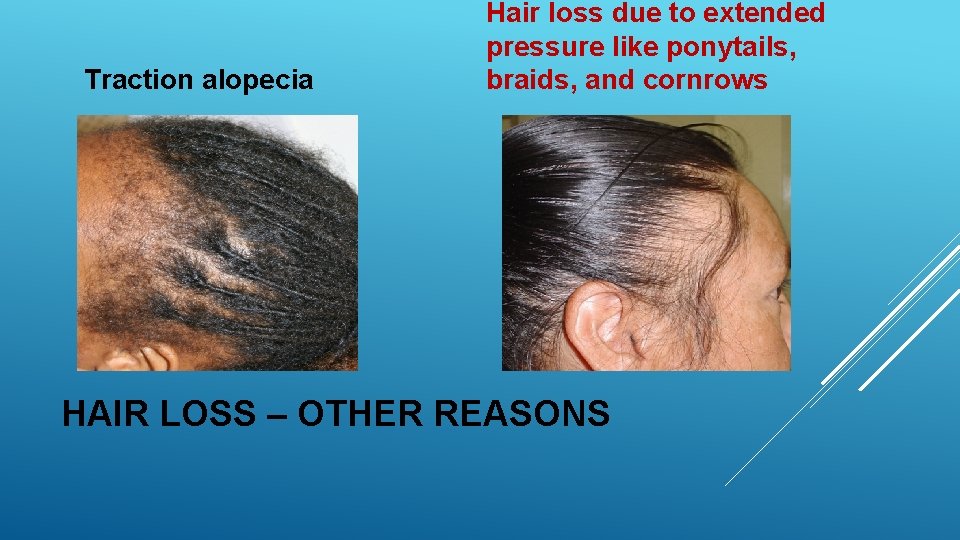 Traction alopecia Hair loss due to extended pressure like ponytails, braids, and cornrows HAIR