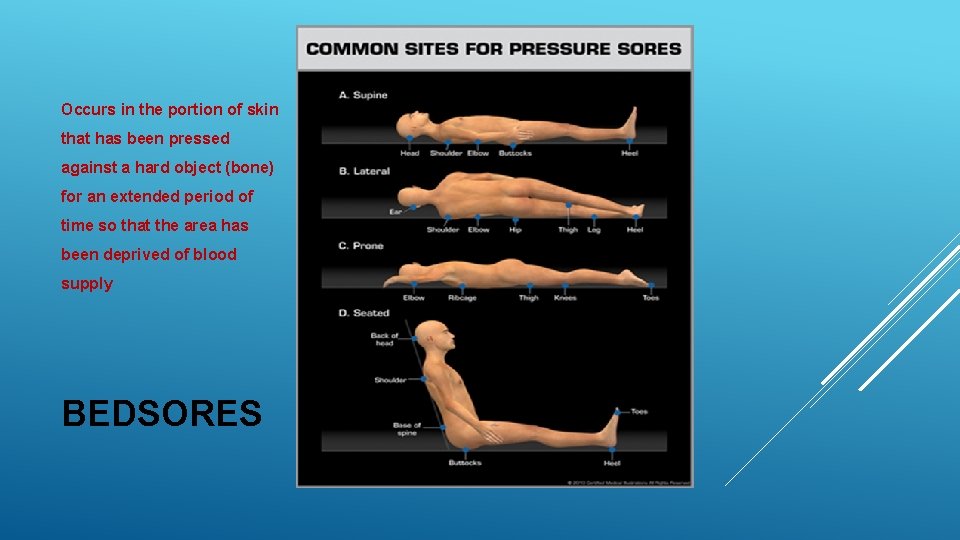 Occurs in the portion of skin that has been pressed against a hard object