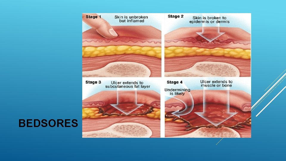 BEDSORES 