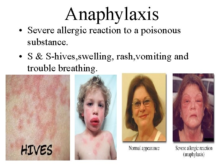 Anaphylaxis • Severe allergic reaction to a poisonous substance. • S & S-hives, swelling,