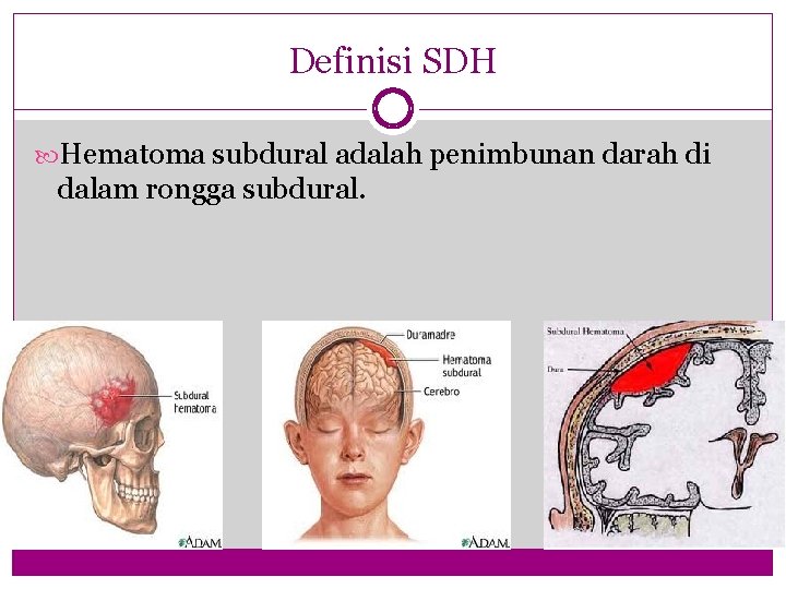 Definisi SDH Hematoma subdural adalah penimbunan darah di dalam rongga subdural. 