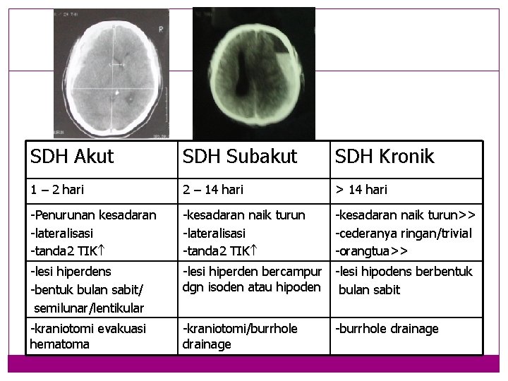 SDH Akut SDH Subakut SDH Kronik 1 – 2 hari 2 – 14 hari