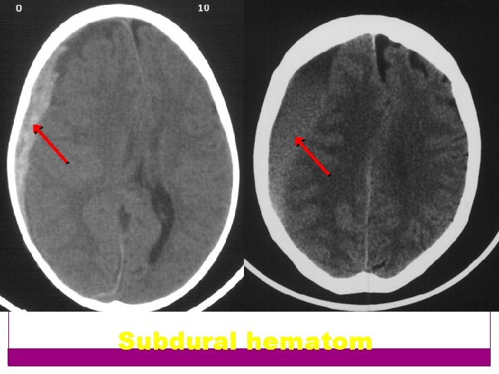 Subdural hematom 