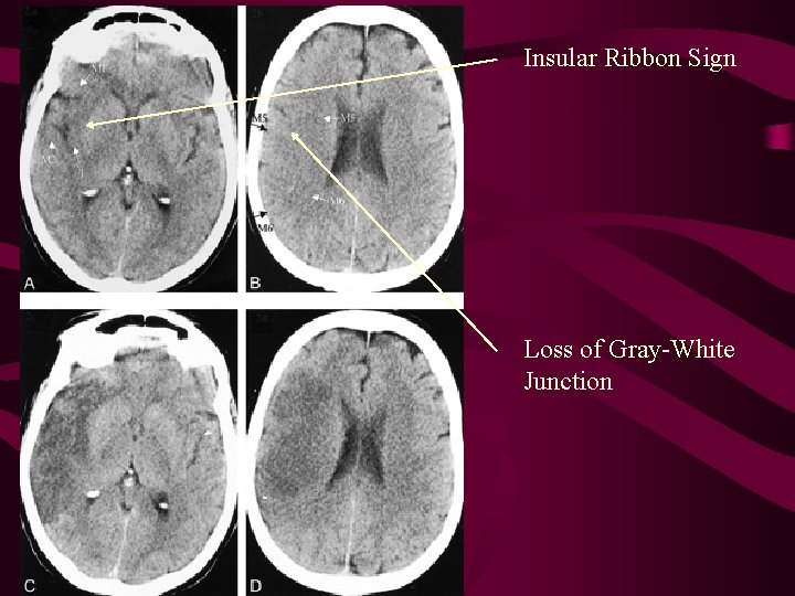 Insular Ribbon Sign Loss of Gray-White Junction 