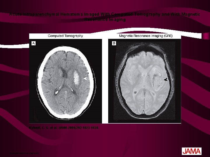 Acute Intraparenchymal Hematoma Imaged With Computed Tomography and With Magnetic Resonance Imaging Kidwell, C.