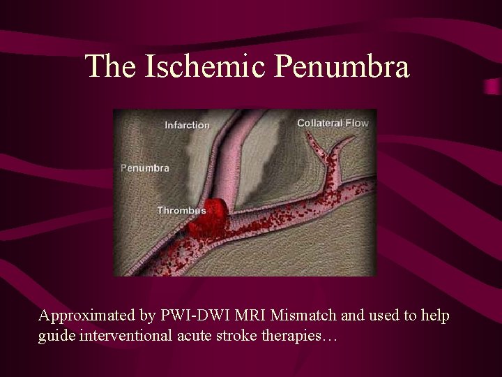 The Ischemic Penumbra Approximated by PWI-DWI MRI Mismatch and used to help guide interventional