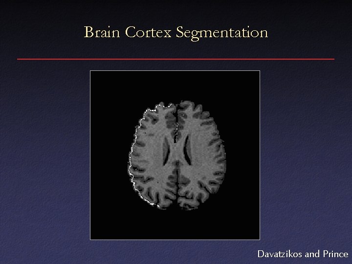 Brain Cortex Segmentation Davatzikos and Prince 