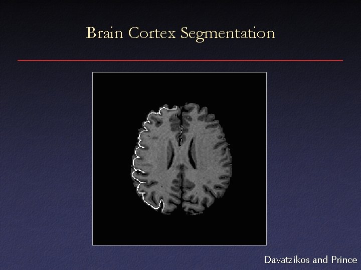 Brain Cortex Segmentation Davatzikos and Prince 