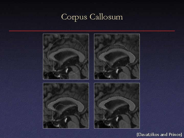 Corpus Callosum [Davatzikos and Prince] 