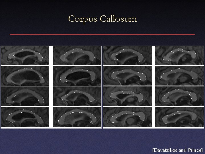 Corpus Callosum [Davatzikos and Prince] 