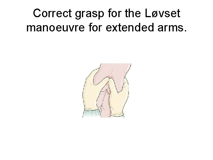 Correct grasp for the Løvset manoeuvre for extended arms. 